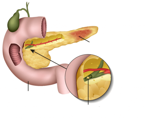 ang pancreatitis usa ka panghubag sa pancreas
